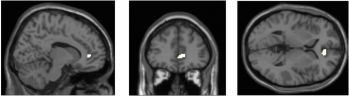 Highlighted areas show where grey matter density was affected